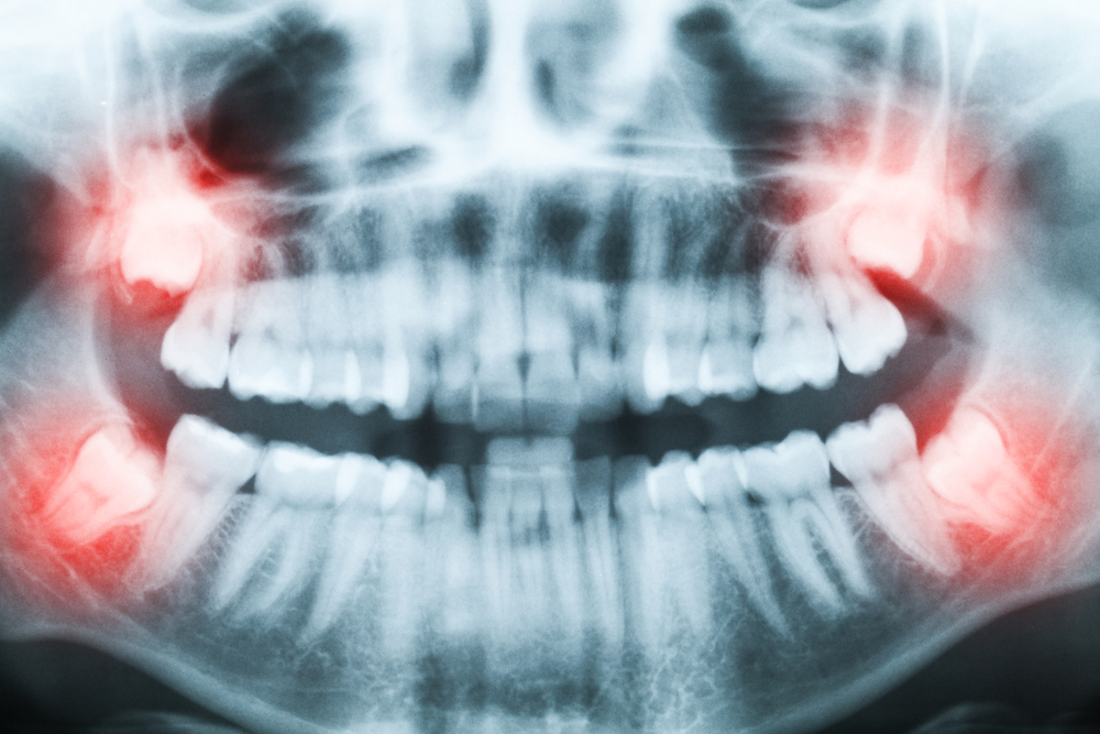 Do I Really Need To Have My Wisdom Teeth Removed?