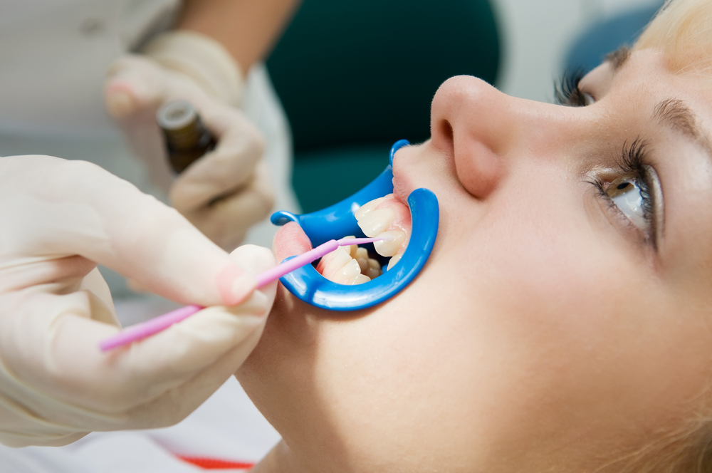 Who Needs Dental Sealants? dental sealants