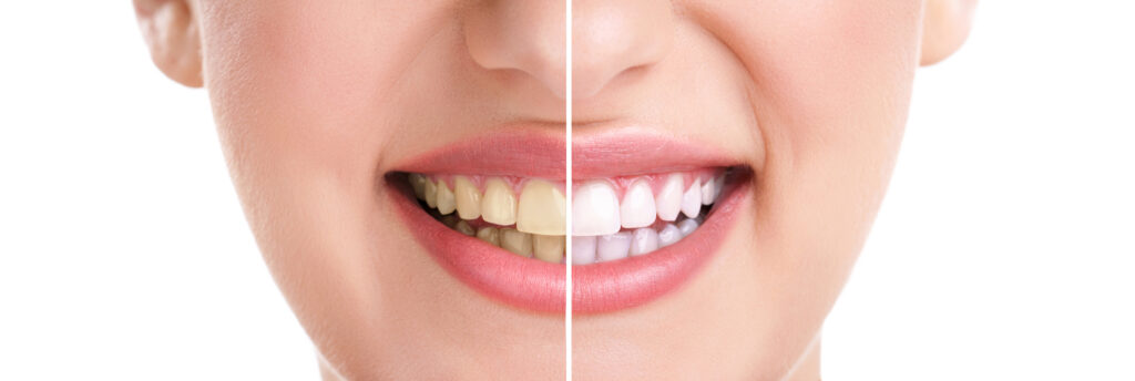 What Color Are Teeth Naturally?