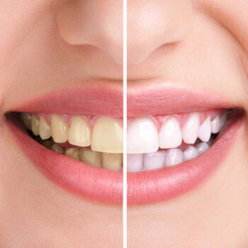 North View Dental teeth North Ogden Utah