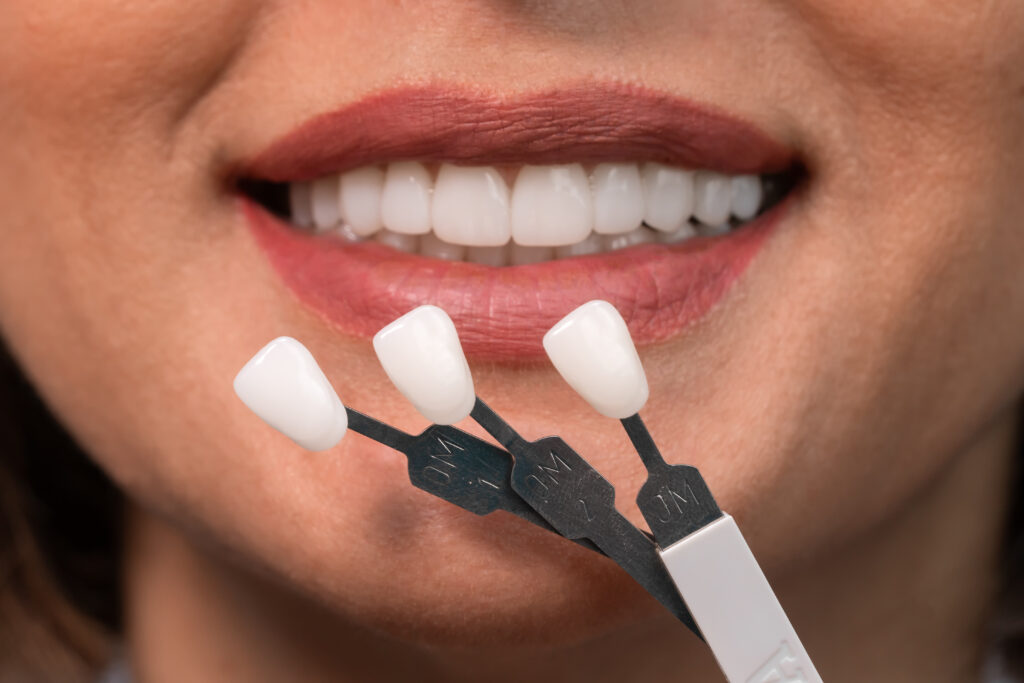 Are You a Good Candidate for Veneers?