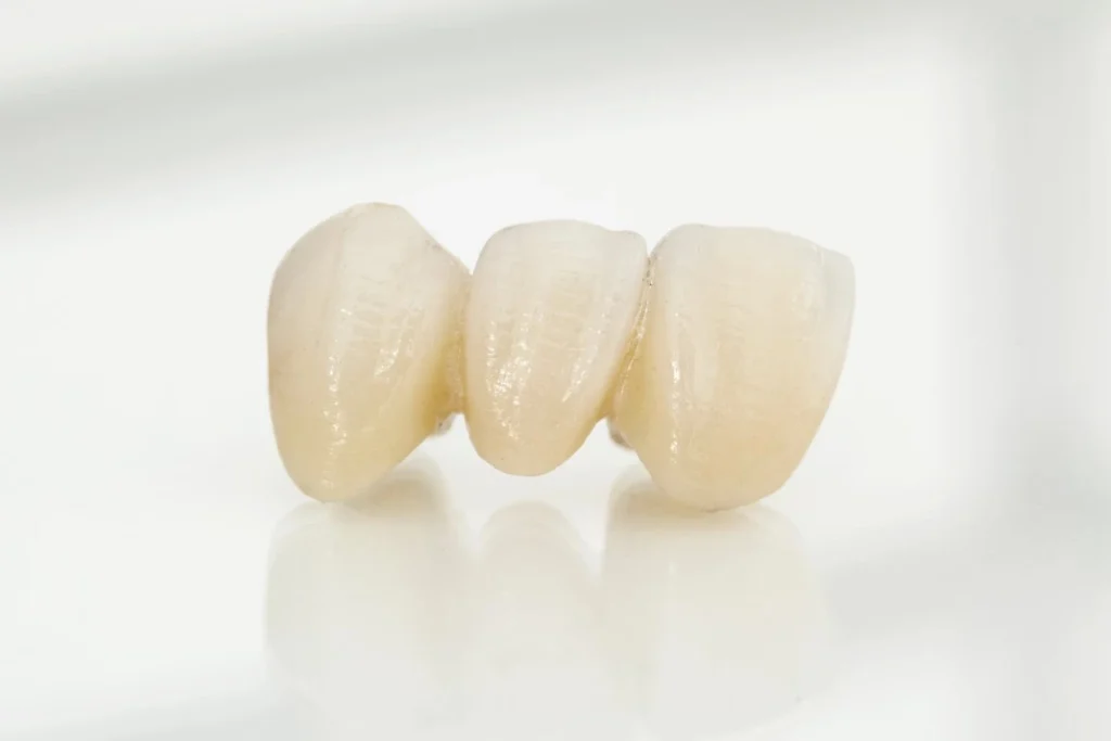 Should You Get An Implant-Supported Dental Bridge? Implant-Supported Bridge - North View Dental, North Ogden, Utah