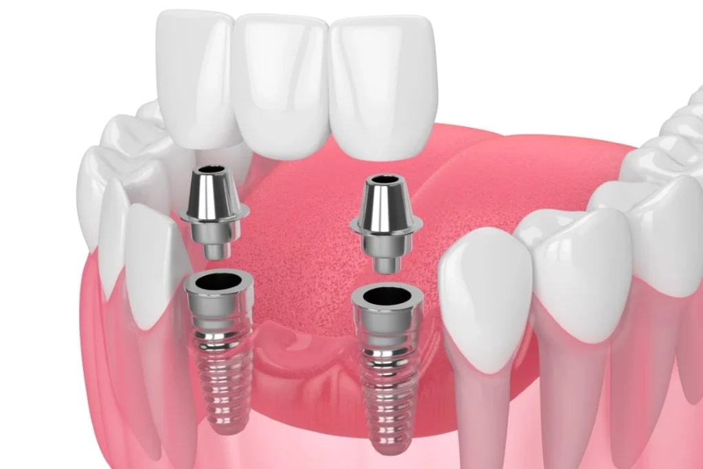 Should You Get An Implant-Supported Dental Bridge? Implant-Supported Bridge - North View Dental, North Ogden, Utah