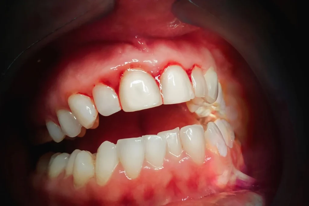 6 Signs You Have Gum Disease