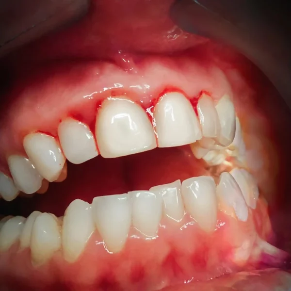 North View Dental Bleeding Gums North Ogden, Utah