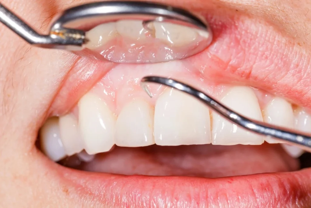 How Gum Disease Impacts Your Heart Health