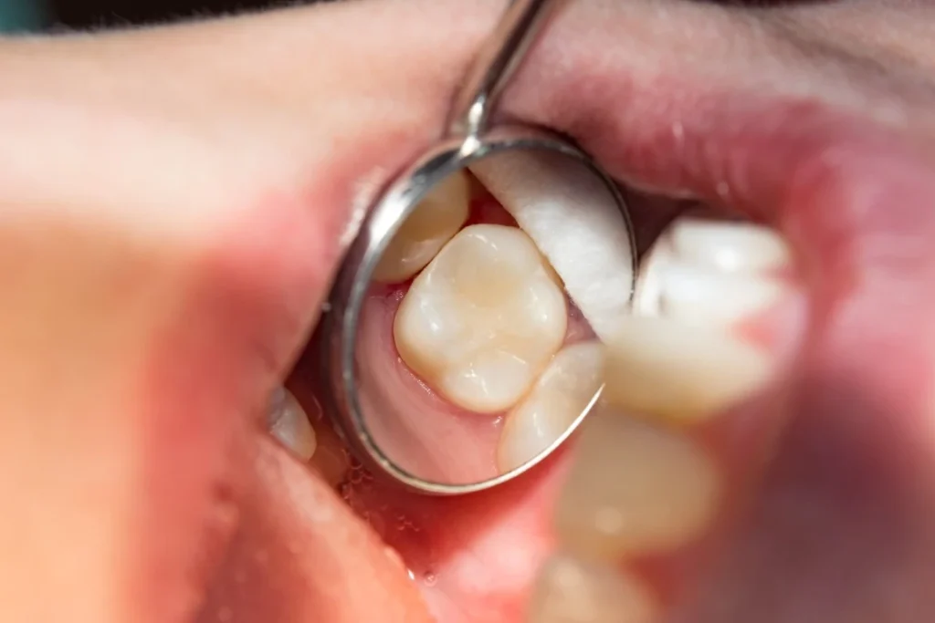 Everything You Need to Know About a Dental Filling