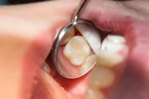 A Dental Filling - North Ogden, UT