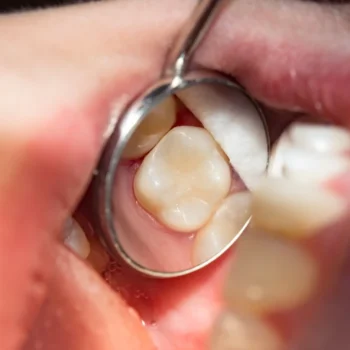 A Dental Filling - North Ogden, UT