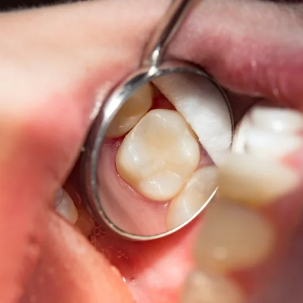 A Dental Filling - North Ogden, UT
