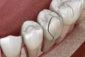 A Cracked Tooth - North Ogden, UT 