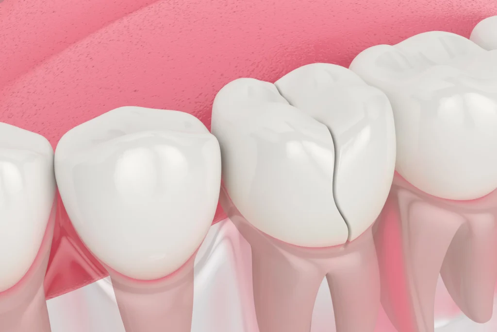 How Does a Dentist Treat a Cracked Tooth?