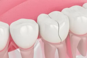 A Cracked Tooth - North Ogden, UT 