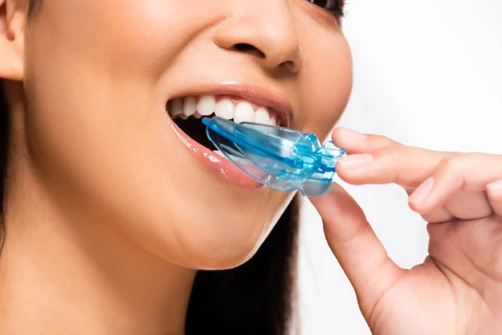 A Definitive Guide to Sports Guards and Protecting Your Smile on the Trails